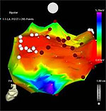 This picture demonstrates the effectiveness of the Convergent procedure. The area in red is the posterior left atium atrium, the site where the majority of triggers for atrial fibrillation are located. The red color indicates that this area has little, if any, residual electrical activity. This demonstrates the elimination of the electrical problems which cause atrial fibrillation.